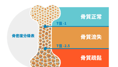 名醫會客室／骨質疏鬆症的預防與治療