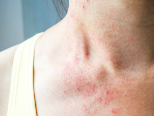 These Pictures Will Help You Identify the Most Common Skin Rashes