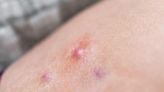 Hammerling-Hodgers: Got small, red bumps? Don't wait. See your dermatologist immediately