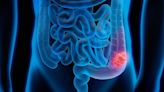 El síntoma de cáncer de colon que fácilmente podrías estar pasando por alto