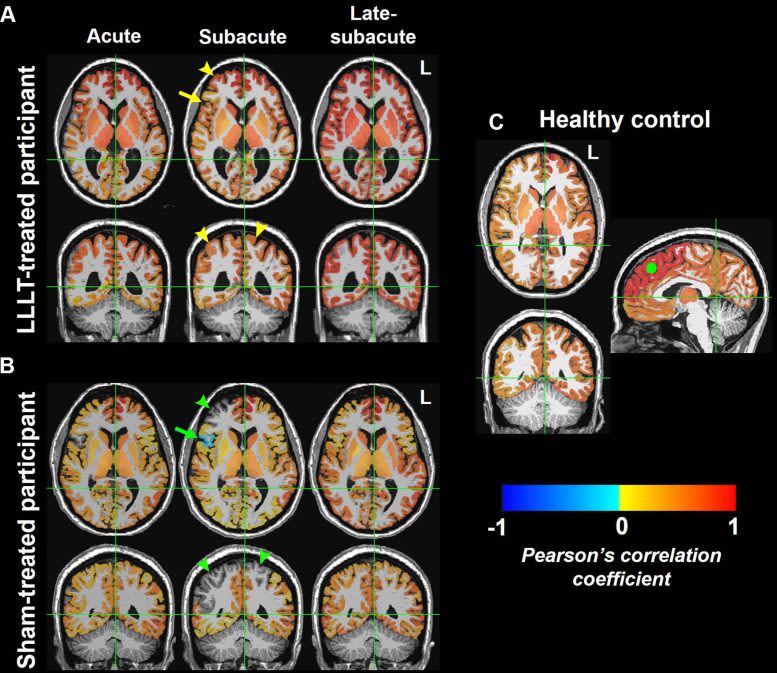 New Study: Light Therapy Enhances Brain Connectivity After Injury