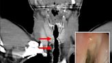 Wiry black hairs grow in the back of man’s throat after decades of smoking