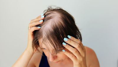 Medicamento para la alopecia fue aprobado en Escocia - La Opinión