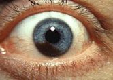 Uveal melanoma