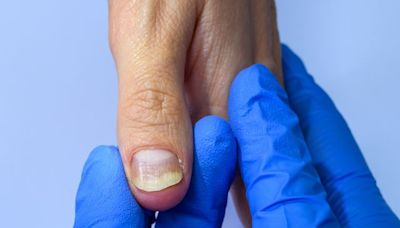 Yellow Nail Syndrome: What to Know