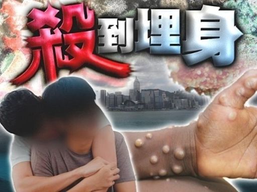 27歲男染猴痘 周日曾訪尖沙咀桑拿並有高風險接觸