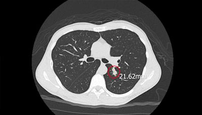 台中男肺部長2cm腫瘤！ 沒出國卻染罕見「美國球黴菌」恐呼吸衰竭