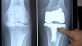 It's 'Move More Month': El Paso surgeon discusses knee replacement - KVIA