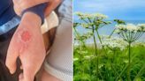 Boy, 8, 'scarred for life' after toxic giant hogweed plant causes blisters and burns