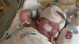 Family didn't know if tiny baby would survive after major surgery at 8 days old