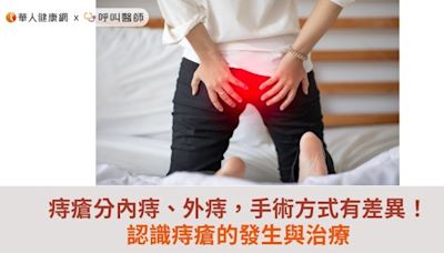 痔瘡分內痔、外痔，手術方式有差異！認識痔瘡的發生與治療 | 蕃新聞