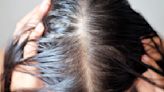 Eating Too Much of This Type of Food May Cause Hair Loss