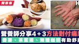 【關節痛】營養師分享4＋3方法對付痛風！吃番薯、茶葉蛋、無糖咖啡有助舒緩痛楚