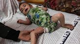 Dangerous skin diseases spreading among Gaza children