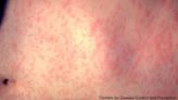 Fifth measles case confirmed in Michigan