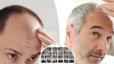 A breakthrough for baldness? Sugar gel stimulates hair regrowth