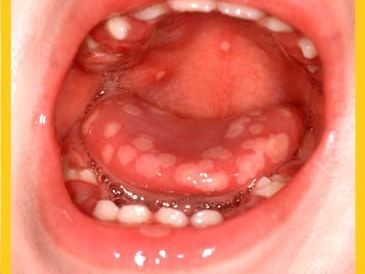 8歲女童口腔潰爛卻非腸病毒 確診「這病」醫說9成人35歲前中過
