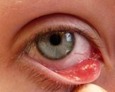 Chalazion