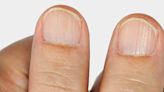 If You Have Nail Ridges, You May Need to See a Doctor ASAP