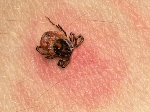 How to protect children from Lyme disease during peak tick season - WTOP News