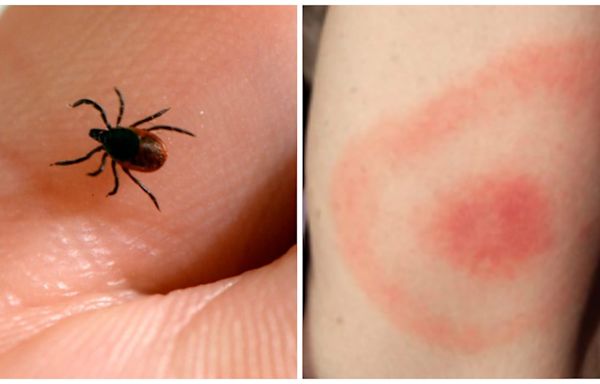 Ticks are back. Here's what experts say you should watch out for