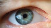 Droopy Eyelid (Ptosis)