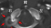 ＜陳建志醫師專欄＞頸椎動脈狹窄 老是聽見噗通噗通