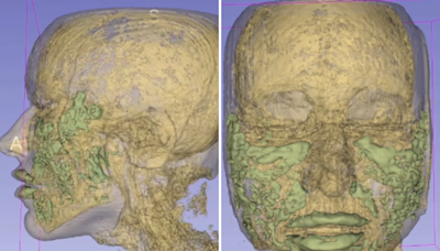 MRI of 33-year-old woman's face shows exactly where her filler ended up