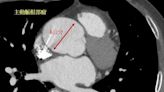 53歲女長期抽菸 健檢才知長了5.3公分主動脈瘤