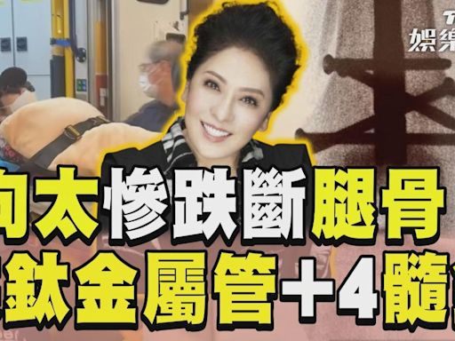 影音／向太浴室慘跌斷腿骨！ 大腿釘鈦金屬管+4髓釘│TVBS新聞網