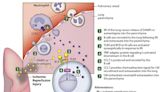 Researchers suggest B-cells may play role in lung transplant rejection