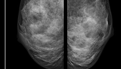 When a Mammogram Misses Breast Cancer