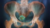 Most women have uterine fibroids. Doctors have no idea why.