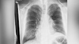 Few Marylanders are screened for lung cancer. Can this new $8M statewide effort change that? - WTOP News