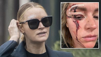 Brave Laura Woods pictured for first time since horror face injury