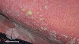 IPC Develops Consensus on Generalized Pustular Psoriasis