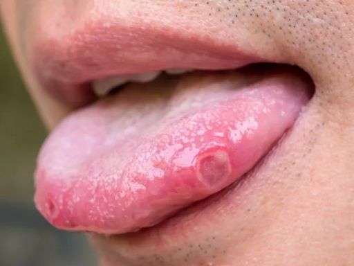 Tongue symptom could be red flag for Covid as new variant causes concern