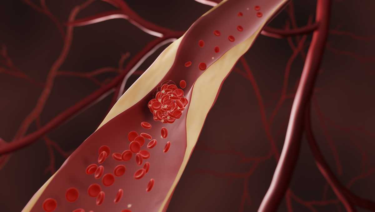What are blood clots and symptoms to look out for
