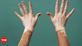 Holistic ways to heal skin disorders like vitiligo and psoriasis | - Times of India