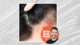 Can Ozempic Cause Hair Loss? Experts Reveal The Truth