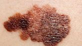 What is melanoma? Your skin cancer questions answered