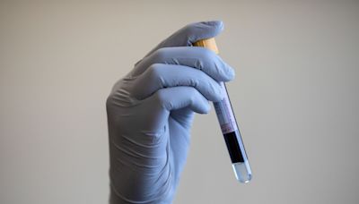 Blood test powered by AI ‘could detect infertility in men without semen testing’
