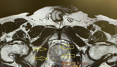 59歲男罹早期攝護腺癌「無創海福刀」手術讓他保雄風 - 自由健康網