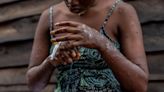 Primeras vacunas contra mpox llegan a la RDC; recibirá 200,000 dosis esta semana