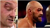 A cutwoman has provided a worrying update on Tyson Fury's injury ahead of Oleksandr Usyk fight