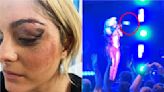 Bebe Rexha recibe puntos en la cara tras ser golpeada con un celular
