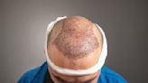 As hair transplants become big business, here’s what you need to know about the risks