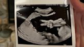 Fetus's gesture in ultrasound photo catches parents by surprise: 'We never saw anything like this before'