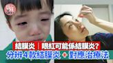 眼紅可能係結膜炎？！分辨4款結膜炎+對應治療法 | am730