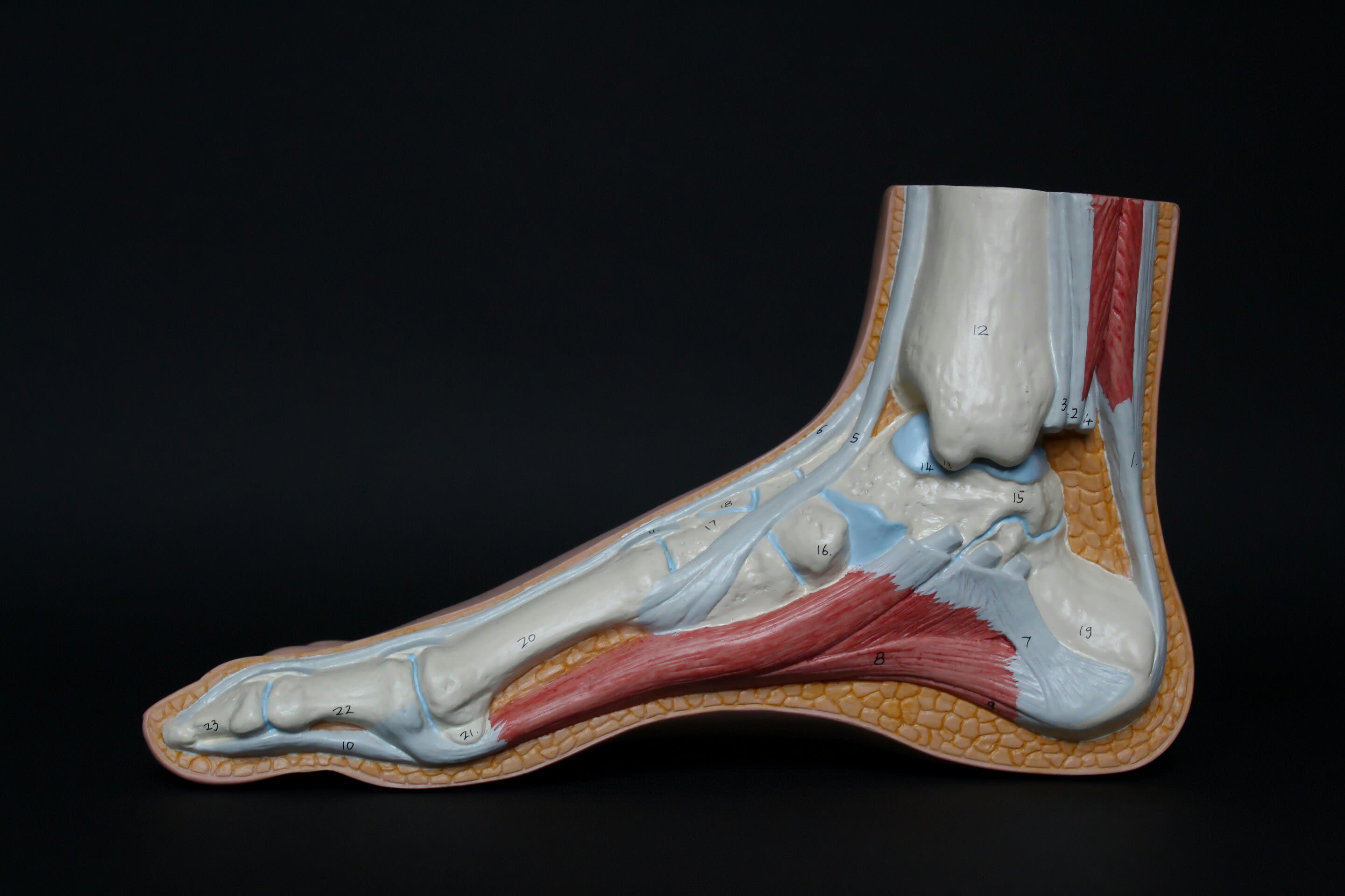 Returning to physical activity after first metatarsophalangeal arthrodesis